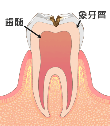 病態【C2】比較的大きい虫歯