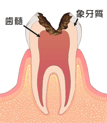 病態【C3】大きく神経まで達している虫歯