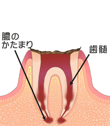 病態【C4】すでに神経を失った虫歯