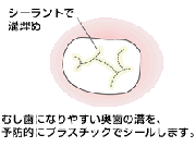 フッ素・シーラント