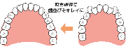 歯並びの種類　咬合誘導