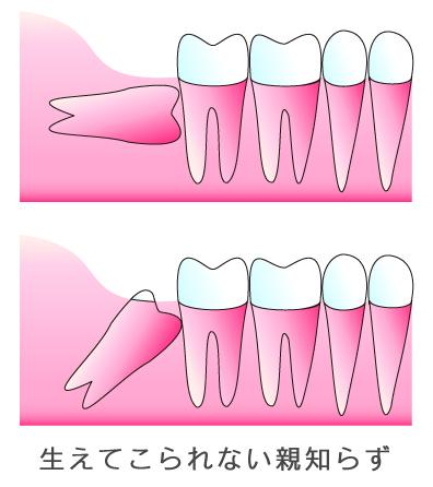 親知らずとは