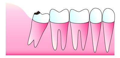 親知らずが虫歯になる