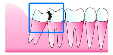 親知らず前の歯が虫歯や歯周病になる